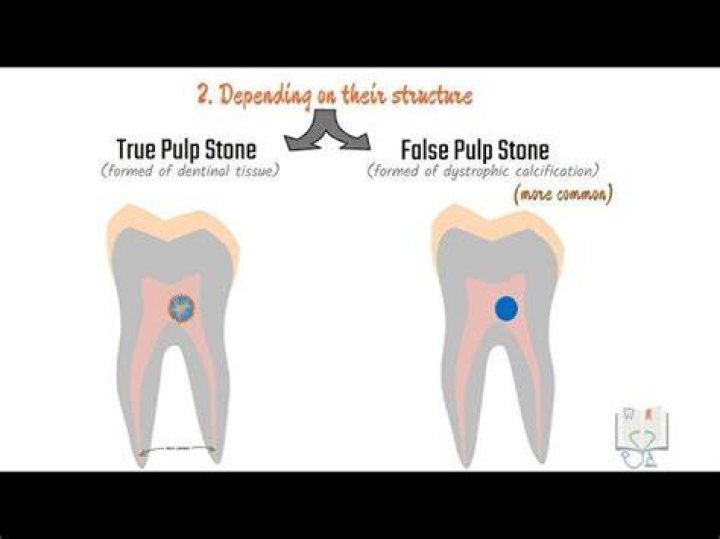 What is a pulp stone?